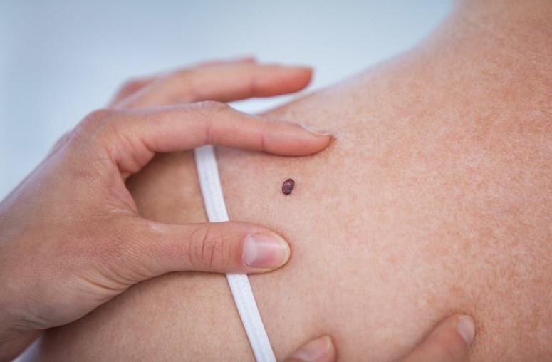 Melanoma: cases on the rise in Italy