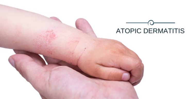 Atopic dermatitis, new drug shows long-term results