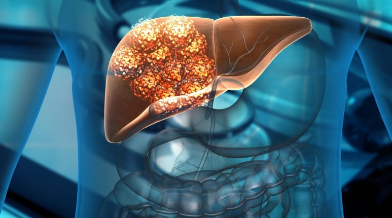 Liver cancer: here's how to predict it