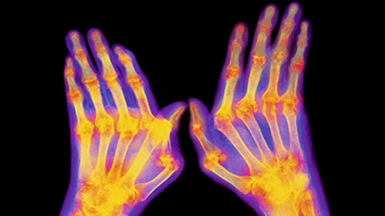 Osteoarthritis of the hand, developed a new drug